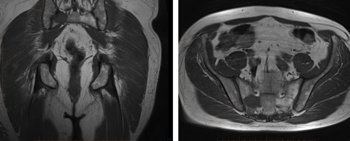 Figure 4 for case Vascular leiomyosarcoma ( RID4387 )